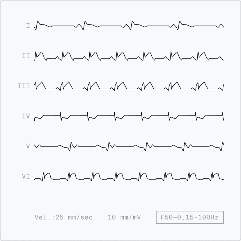 ECG electrocardiogram
